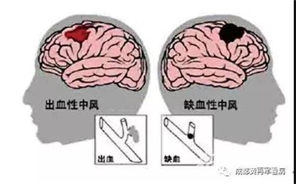微信图片_20180912152327.jpg脑中风2.jpg